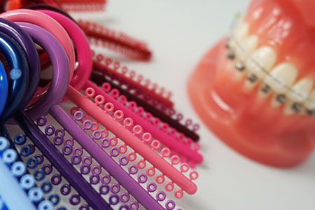 Czy aparat ortodontyczny powoduje próchnicę? – FAQ