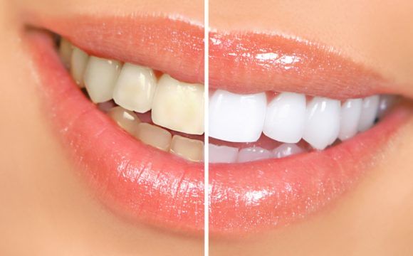 Czym jest profesjonalna higienizacja zębów i dlaczego stomatolog zalecił jej wykonanie?