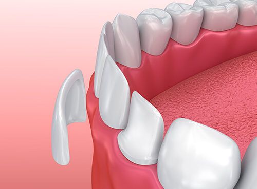 Co to są licówki dentystyczne?